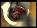 Discectomy Discectomy