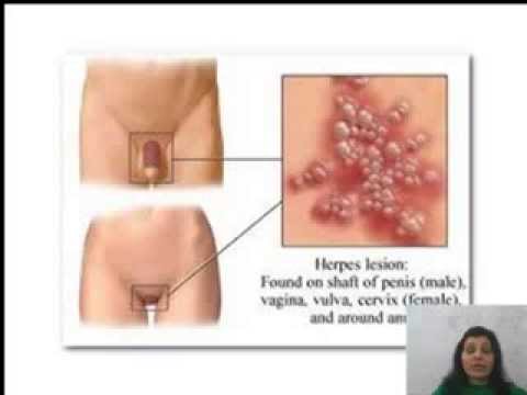 how to cure oral herpes