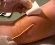 PICC Line Removal