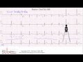 ECG Interpretation, Advanced Level - Part 8 ECG Interpretation, Advanced Level - Part 8