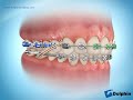 Parts of Braces