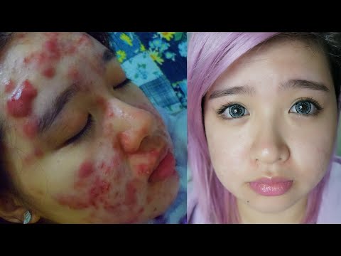 My Acne Story   1 Year Post Treatment Skin Update