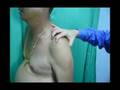 Instability And Sulcus Test For Shoulder Dislocation Assessment Instability And Sulcus Test For Shoulder Dislocation Assessment