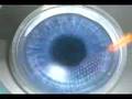 Lasik