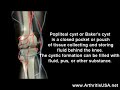 Knee pain and Baker\