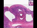 Histopathology Ovary- -Polycystic ovarian disease (Stein-Lev Histopathology Ovary- -Polycystic ovarian disease (Stein-Lev