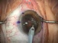 Modern Cataract Surgery: Alcon ReSTOR IOL with LRI