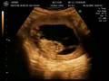 videos de Ultrassom 3 meses do Klauss