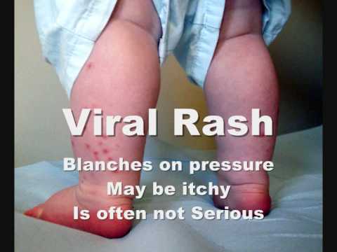 how to glass test for meningitis