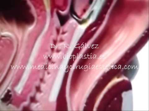 Bioplastia del placer sexual Punto G vaginal y aumento del grosor del pene. Dr Gálvez .Macrolane