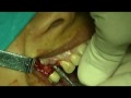 implant dental video preview 01