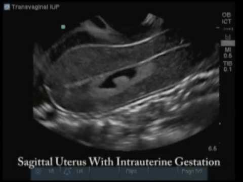how to locate placenta on ultrasound