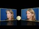 videos de Facial Surgery Specialist at Silkwood Medical in Sydney - Dr. Warwick Nettle