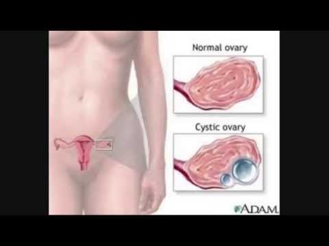 how to relieve ovary pain