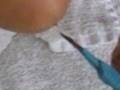 Olecranon Bursitis (Popeye Elbow)-