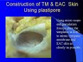 Learning tool for tympanic membrane surgeries Dr GKNarayana