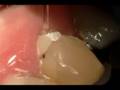 Waterlase removing cavities with no shots LaserDentistry.com