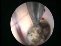 Third Ventricle Cyst Surgical Access Third Ventricle Cyst Surgical Access