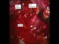 Prostatectomia Radicale Robotica: nerve sparing Aphrodite