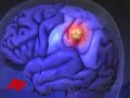 Ted Kennedy Has Brain Tumor