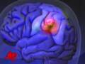 Ted Kennedy Has Brain Tumor