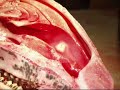 IntraLift Technique