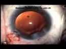 Multifocal SN60D3 ReStor IOL with LRI Multifocal SN60D3 ReStor IOL with LRI