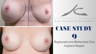 15yo Ruptured and Bottomed Out Implant Repair: CS 9 Julie