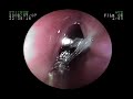 ENDOSCOPIA EN NI�O DE 10 A�OS CON ALAMBRE EN EL ESOFAGO POR COMER EN TACOS DON PANCHO
