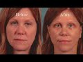 Quick Recovery Facelift Quick Recovery Facelift