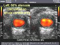 Importance of IMT in measuring PLANIMETRIC carotid stenosis