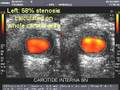 Importance of IMT in measuring PLANIMETRIC carotid stenosis