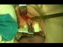 implant dental video preview 03