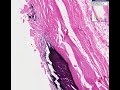 Histopathology Aorta --Atherosclerosis