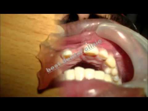 how to treat avulsed tooth