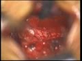 Microdiscectomy in the Lumbar Region Microdiscectomy in the Lumbar Region