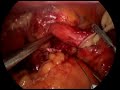 Laparoscopic Nissen Fundoplication