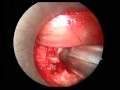 L5-S1 Endoscopic Slipped Disc Removal 