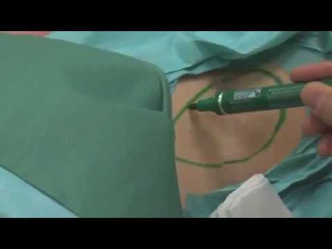 how to cure axillary hyperhidrosis