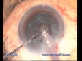 Phacoemulsification with foldable intraocular lens implantation under topical anesthesia