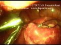Laparoscopy Perforation Closure Full Video - Lap / keyhole