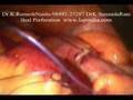 Laparoscopy Perforation Closure Full Video - Lap / keyhole