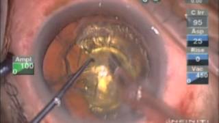 Laser Cataract Surgery