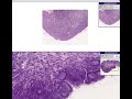 Histopathology Lymph node Follicular hyperplasia Histopathology Lymph node Follicular hyperplasia