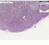 Histopathology Lymph node Follicular hyperplasia