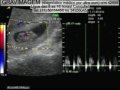 GRAVIMAGEM 283 (ultra-som trans-vaginal do primeiro trimestre da gravidez)