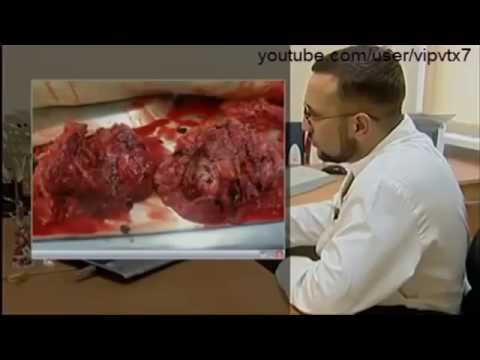 Наркоманы гниют заживо! Ужас! Смотри! Видео 2