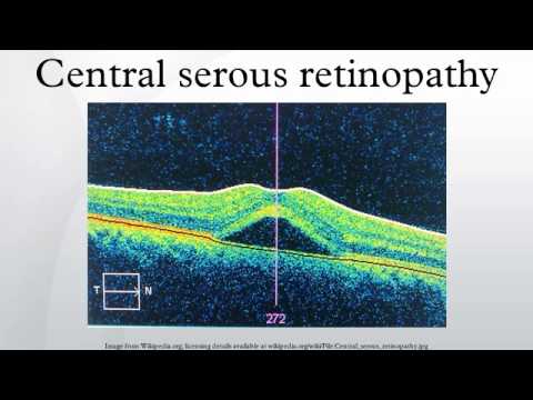 how to cure csr eye