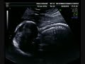 Down syndrome:&nbsp;S�ndrome de Down: diagn�stico fetal