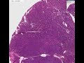 Histopathology Lung--Small cell carcinoma
